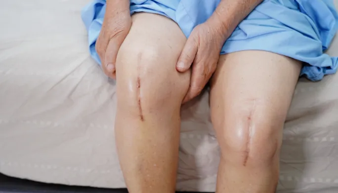 Patient recovering after knee replacement surgery